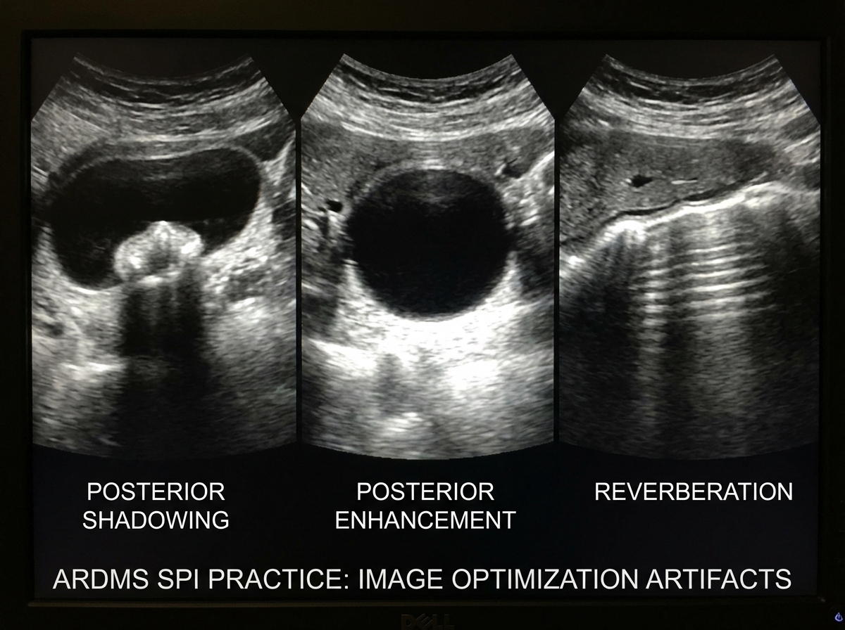 Ultrasound image artifact comparison showing posterior acoustic shadowing beneath gallstone, posterior enhancement beneath fluid-filled cyst, and reverberation lines — ARDMS SPI image optimization practice